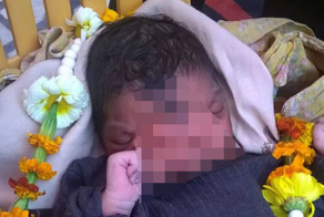 В Индии девочка родилась с хоботом