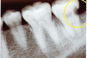 Как не перелечить зубы