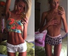 Девушка победила анорексию и участвует в конкурсе красоты