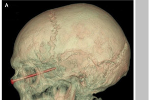 Вылетевший из-под газонокосилки гвоздь, воткнулся мужчине в глаз