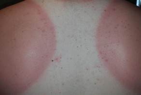 16 причин не наносить крем от солнца