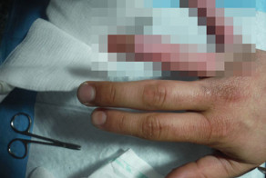 Парень отморозил пальцы на руке в горах