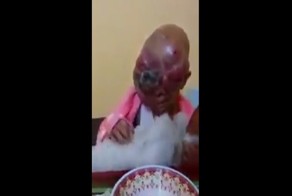 Младенец с опухолью на лице