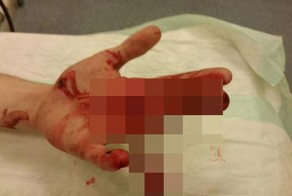 Зацепился за проволоку рукой