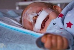 Австралийские хирурги сделали новое лицо для мальчика