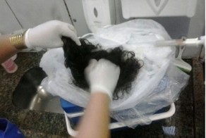 Лишилась кожи на голове в аварии