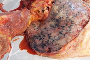 Рак легкого в разрезе (6 фото)