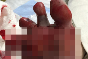 Парню пришлось отрезать кусок ступни