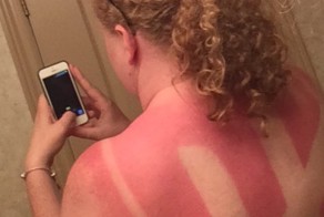 Как вылечить солнечные ожоги и продолжить наслаждаться летом