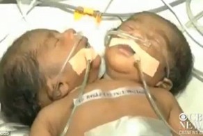 В Индии родился двухголовый ребенок (2 фото)