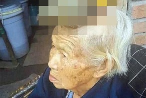 На голове бабушки вырос 13-сантиметровый рог