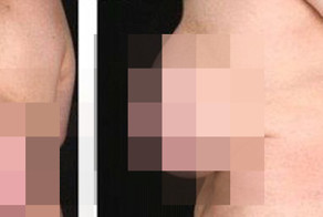 Огромное образование на спине женщины