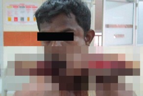 Дерево проткнуло мужчине челюсть