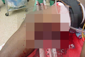 Металлический профиль проткнул ногу мужчины