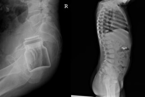 Инородные предметы в интересных местах