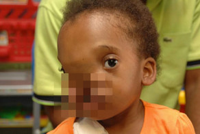 Девочке отрастили новую черепную коробку