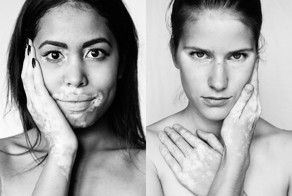 9 впечатляющих снимков, открывающих красоту витилиго