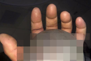 Последствия укуса гремучей змеи