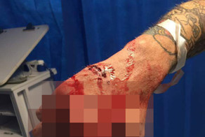 Последствия неосторожной работы с электропилой