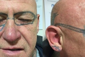 Пожилой британец 2 года удалял очки-тату, которые ему «набили», пока он спал пьяный