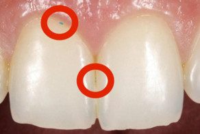 К чему может привести попадание ЭТОГО на зубы