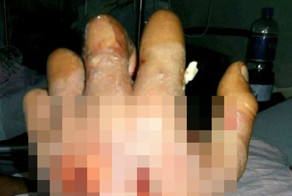 Результат поражения электрическим током