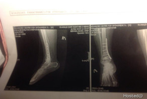 Неудачное падение с переломом ноги