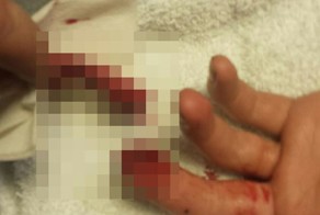 Грузчик немного укоротил свой палец