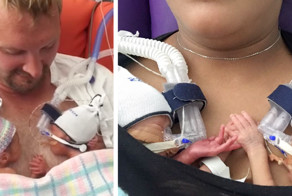 Недоношенные близнецы, держащиеся за руки, покорили интернет