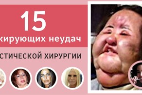 15 шокирующих неудач пластической хирургии