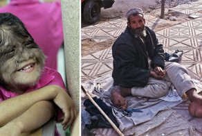 8 редких и страшных заболеваний, в которые невозможно поверить