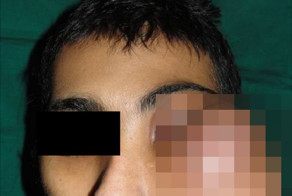 Редчайший случай синовиальной саркомы