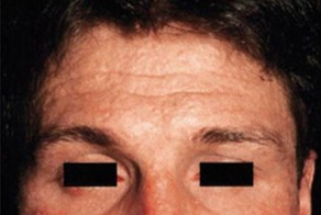 Аллергическая реакция, при которой происходит отслоение верхнего слоя кожи