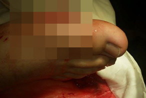 Поранил ногу, бегая в саду