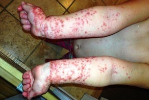 Ужасная сыпь на теле маленького мальчика