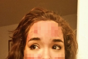 Бывшая наркоманка не может прекратить ковырять свое лицо