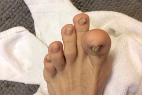 Лечение вросшего ногтя на большом пальце ноги