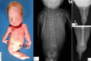 Младенцы с синдромом русалки