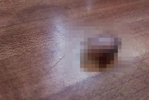 Парень лишился кусочка пальца