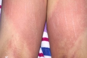 Ученик начальной школы использовал школьный туалет и пришел домой с ожогами второй степени