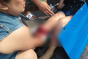 Нога девушки после мотоаварии