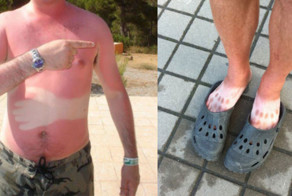 14 солнечных ожогов, которые настолько же смешные, насколько они болезненные