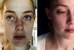 Новые фотографии Эмбер Херд демонстрируют еще больше побоев, якобы нанесенных Джонни Деппом