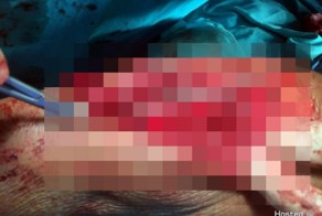 Старушка упала и раздробила локоть