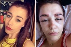 Не в бровь, а в глаз: девушка хотела сделать себе модные брови, а получила страшную аллергическую реакцию