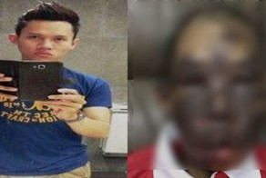 Малайзийский парень с раком кожи