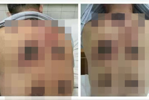 Китаец перестарался с медицинскими банками