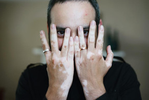 17 жизнеутверждающих фото от людей с витилиго