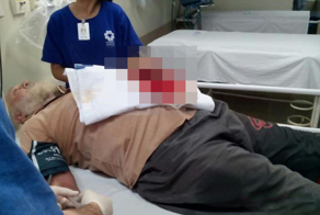 Неосторожный мужик лишился четырех пальцев