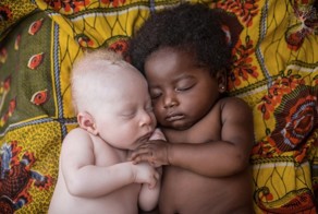 Невероятно: люди-альбиносы в Конго!